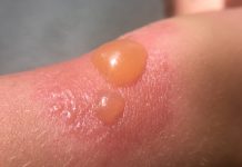 Sunburn posing painful threat