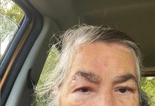 The painful reality of shingles