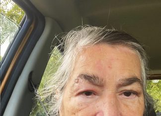 The painful reality of shingles